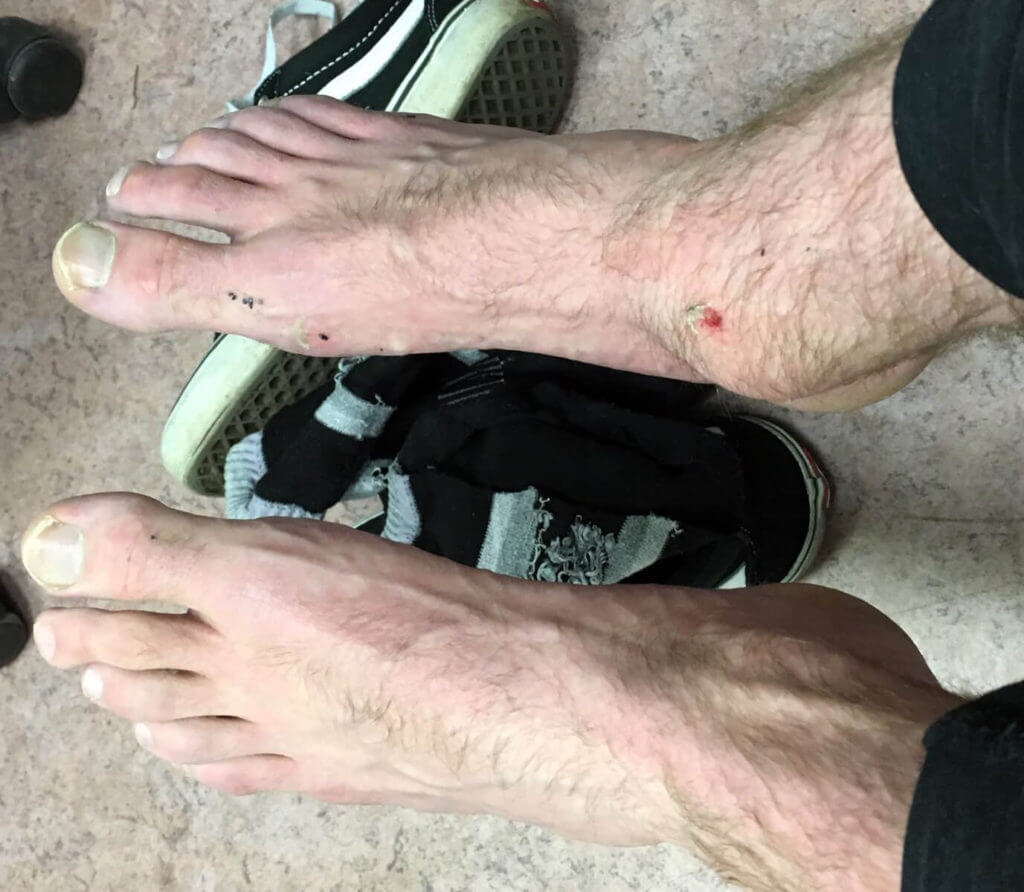 Sprained Ankle... or Snowboarder's Ankle? Onyx Snowboard School