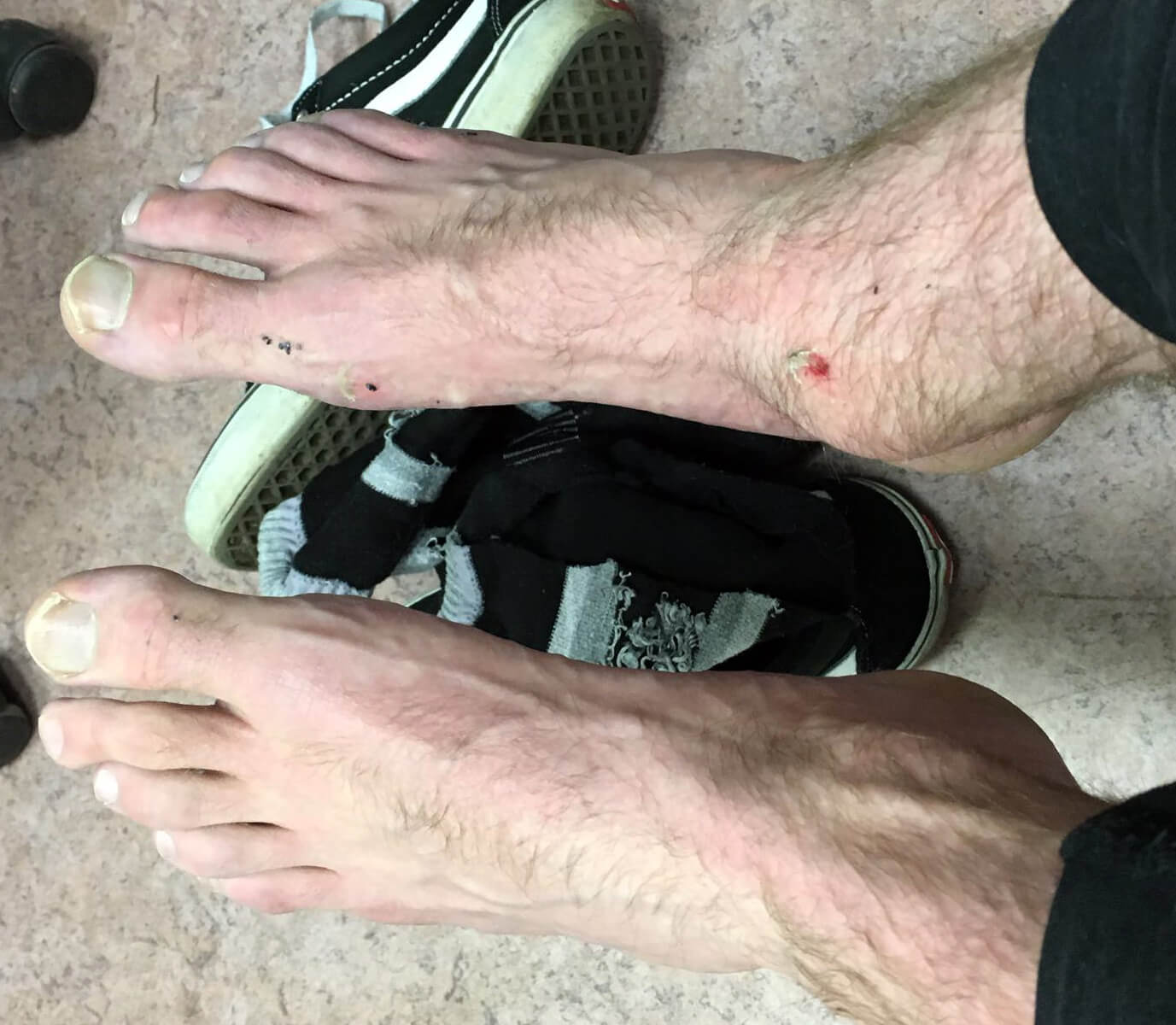 Sprained Ankle... or Snowboarder's Ankle? Onyx Snowboard School